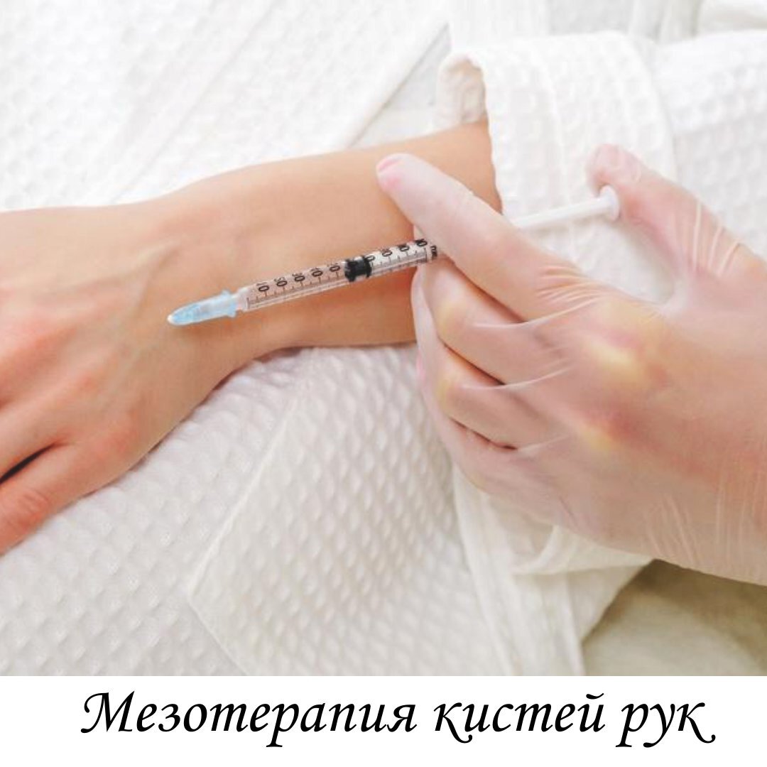 Мезотерапия кистей рук
