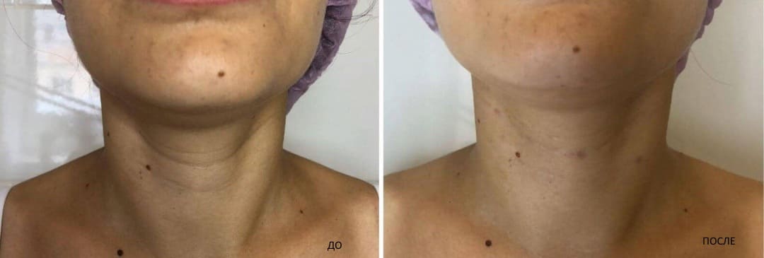 Процедуры для кожи шеи до и после